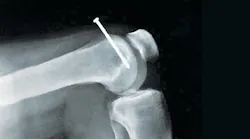 nail injuries can be far too common for remodelers