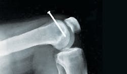 nail injuries can be far too common for remodelers nail injuries can be far too common for remodelers