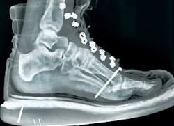 Nail Through Foot2 Nail Through Foot2